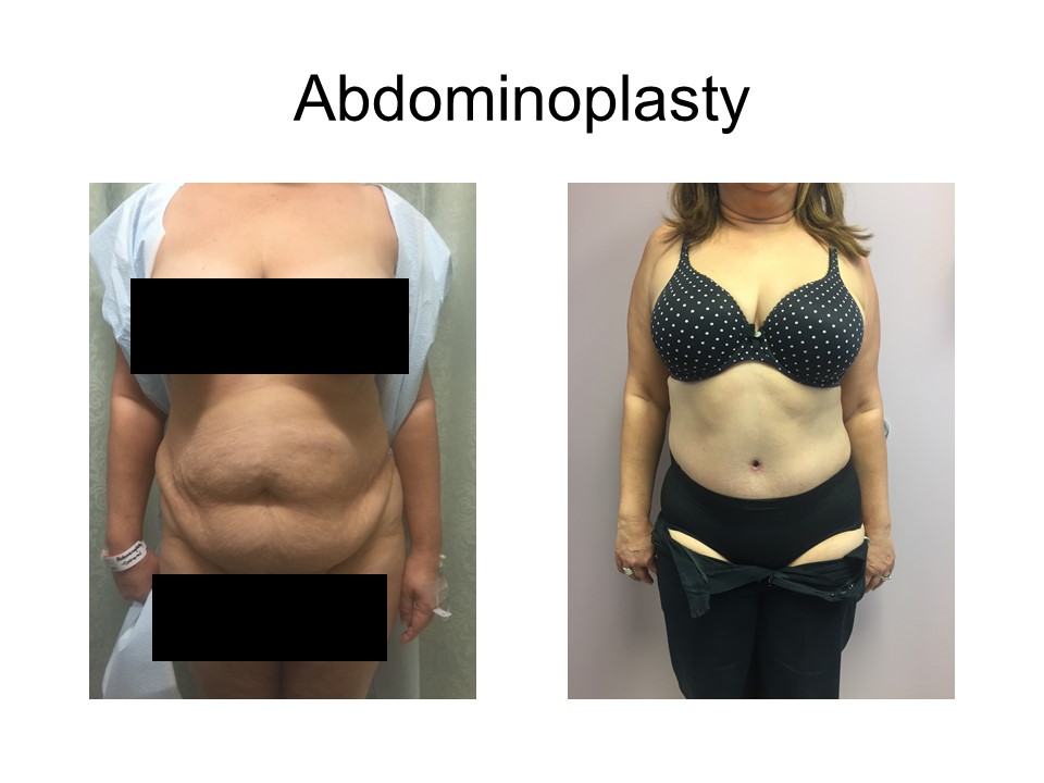 Abdominoplasty Khoury Plastic Surgery_AA