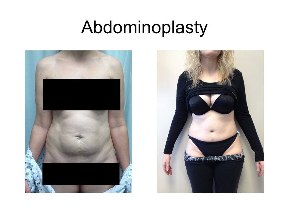 Abdominoplasty Khoury Plastic Surgery_RD